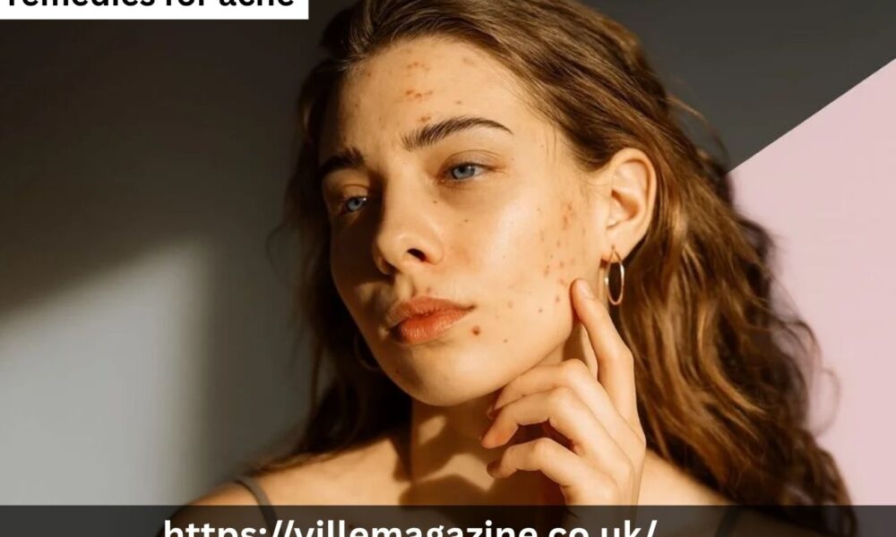 Remedies for Acne