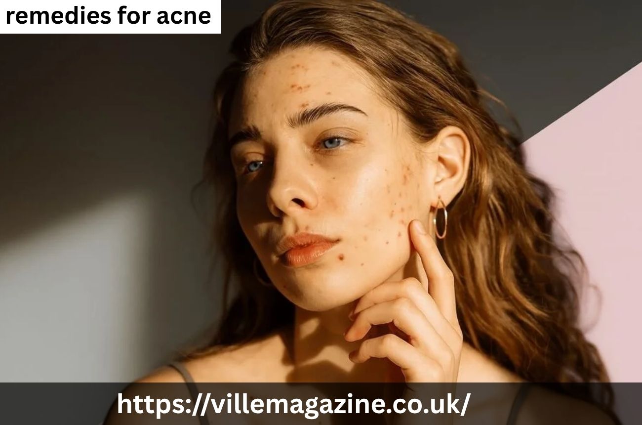 Remedies for Acne